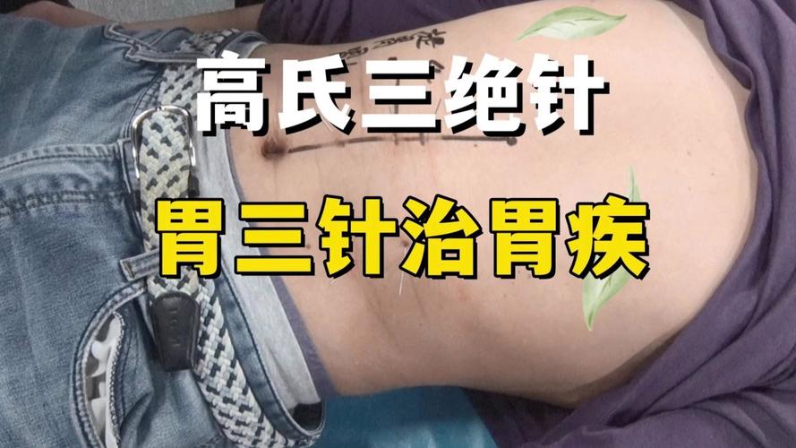 针灸肠胃不好扎哪里