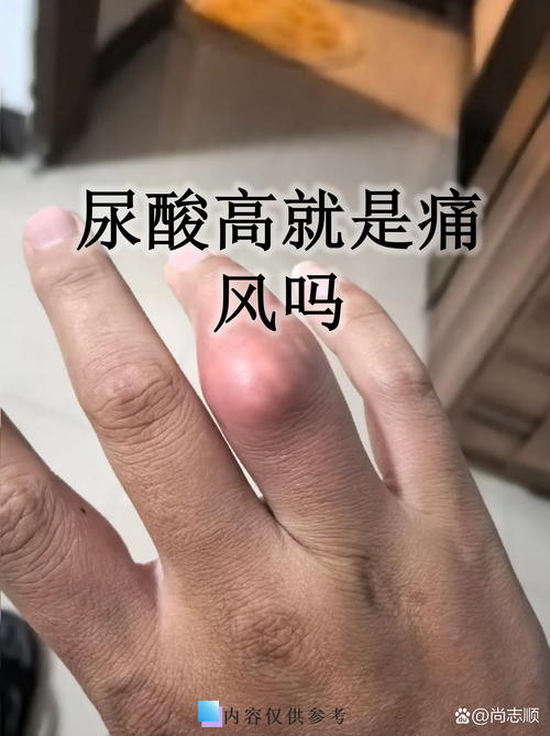 尿酸与痛风有什么关系