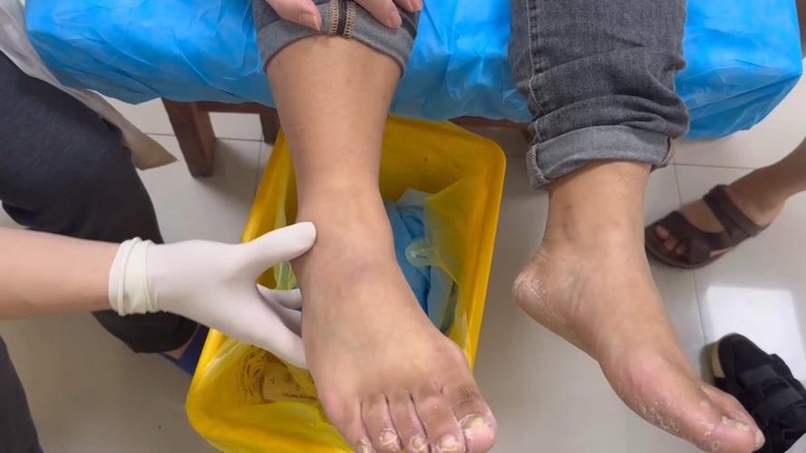 脚踝积液可以针灸吗