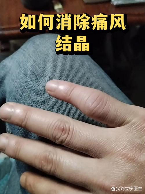 痛风脚结晶怎么能消除