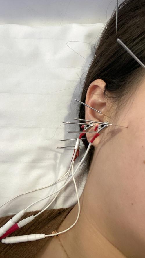 耳鸣的针灸治疗穴位