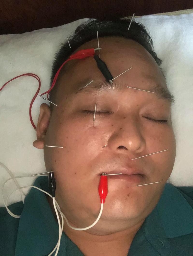 针灸治疗面瘫有疗程