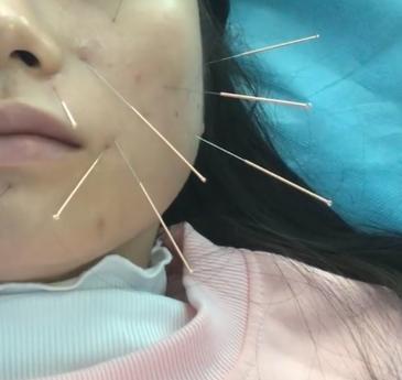 面瘫时间几天针灸好