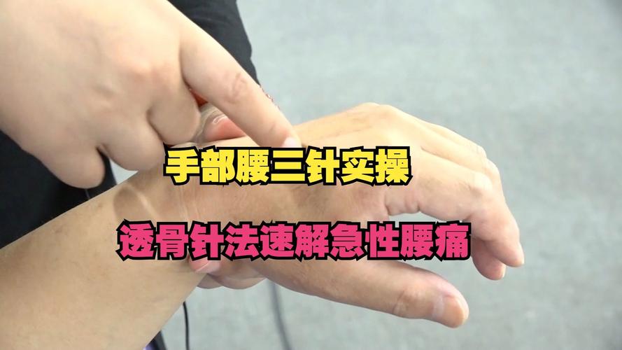 针灸可以治疗腰疼吗