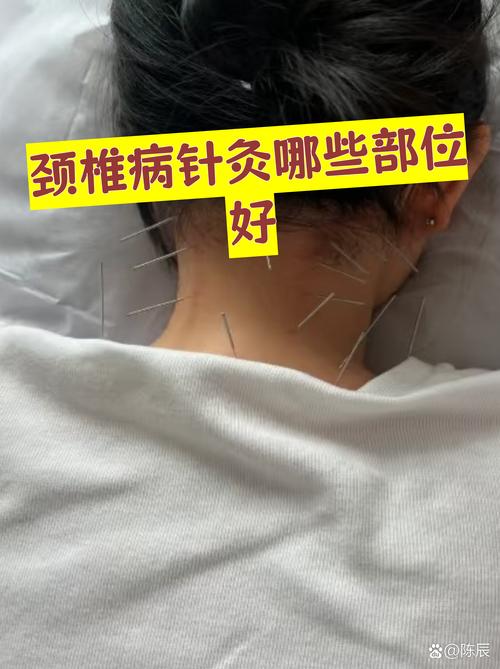 来月经可以颈椎针灸