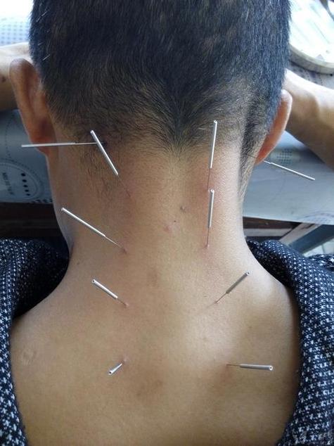 来月经可以颈椎针灸