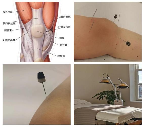 膝盖受寒可以针灸吗