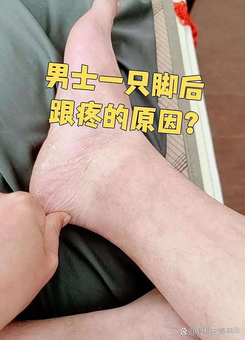 一只脚后跟疼是痛风吗