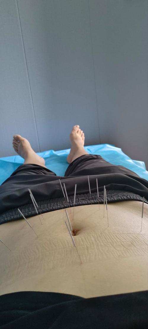 磁疗热能针灸器减肥