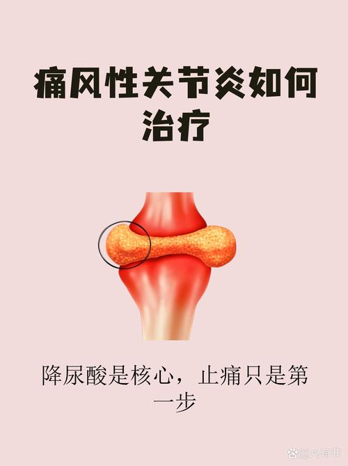 痛风性关节炎如何根治
