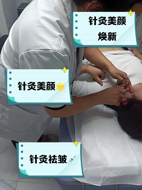 面部松弛可以针灸吗