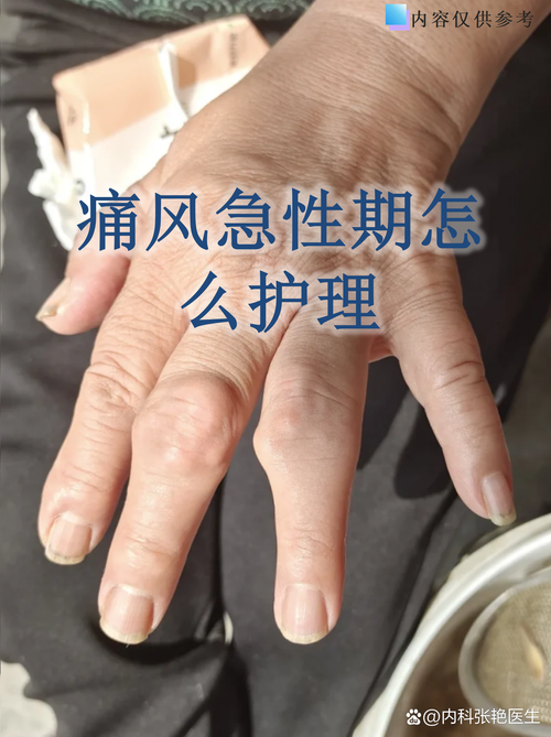 痛风的临床表现及治疗