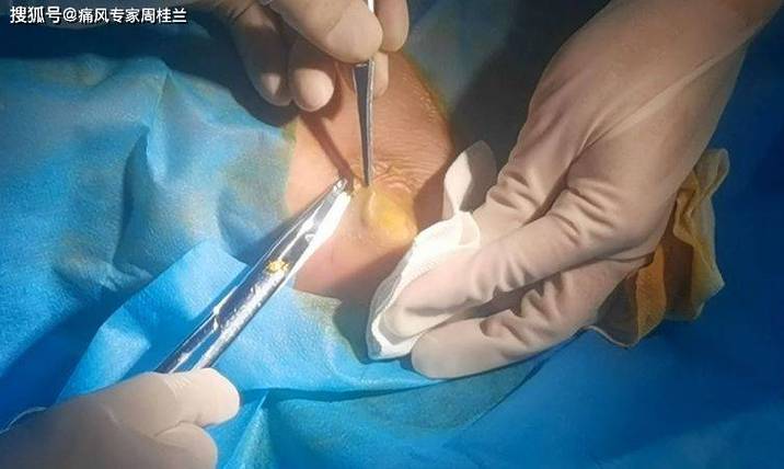 痛风化验血看哪些指标