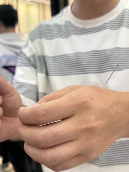 沈阳中医针灸哪家好