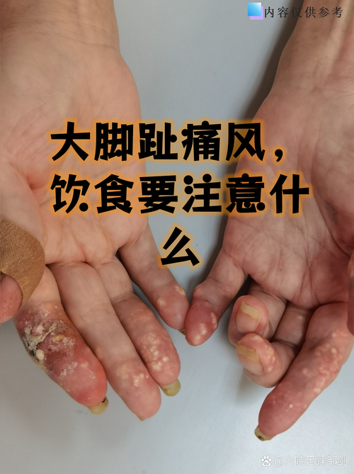 痛风最严重是什么结果