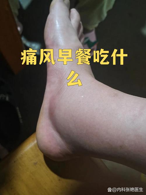 脚痛风吃什么食物最好