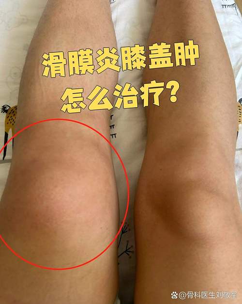 痛风引起滑膜炎的症状