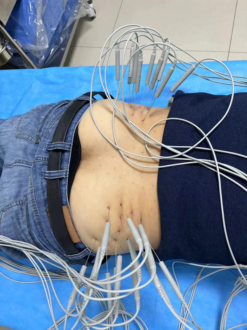 哪可以买到针灸银针