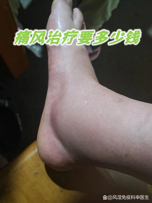 痛风做手术一般多少钱