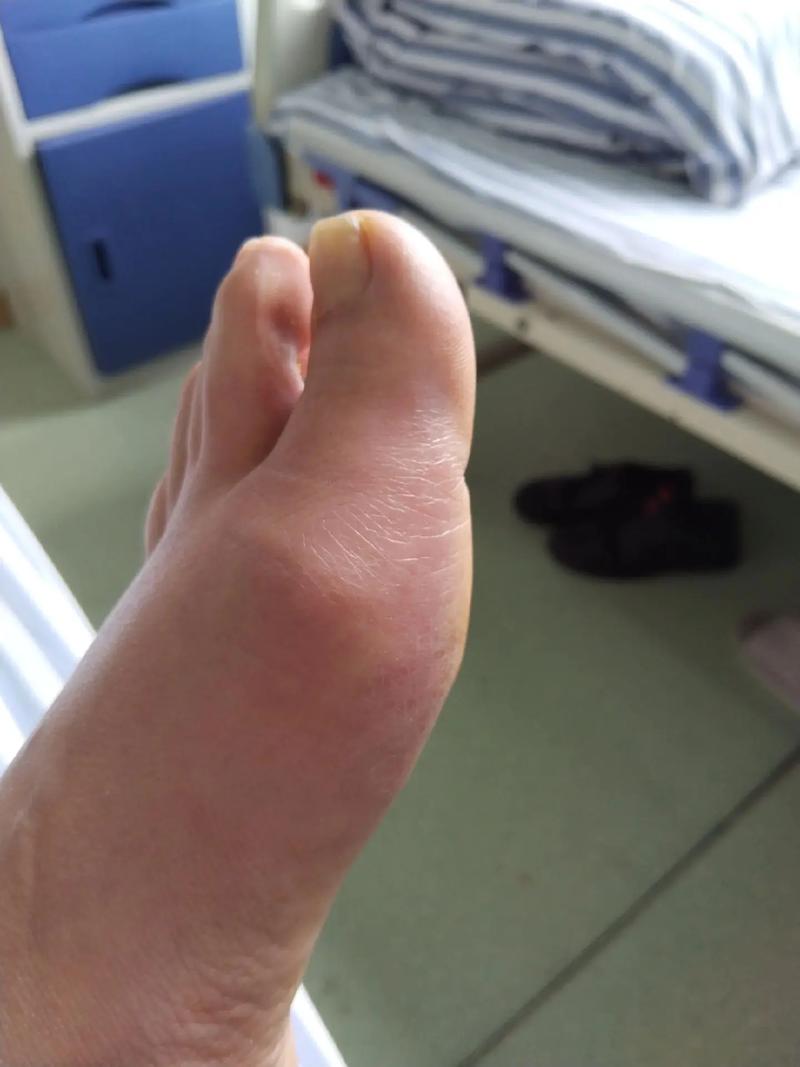 痛风做手术一般多少钱