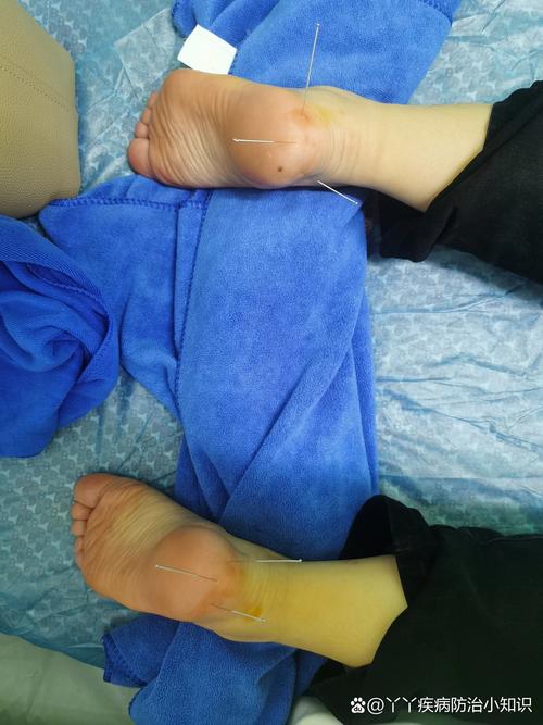 足跟痛针灸治疗图片