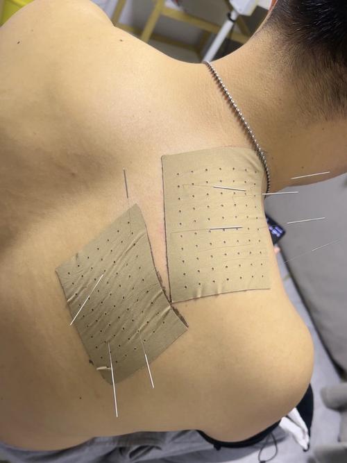 甲状腺肿大针灸位置