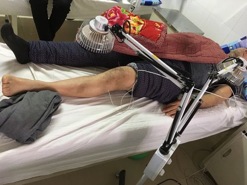 康复理疗可以针灸吗