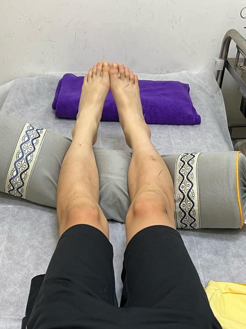脚踝旧伤可以针灸吗