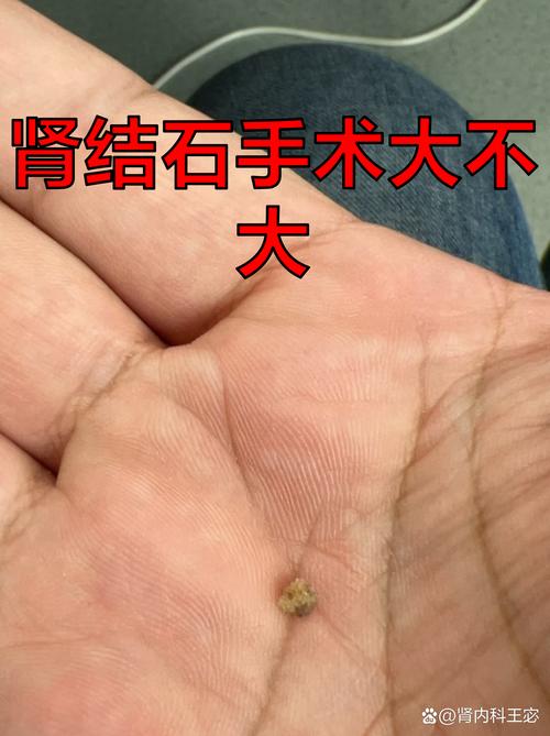 肾结石微创手术安全吗