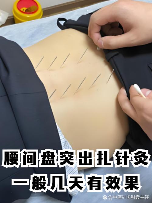 腰椎增生可以针灸吗