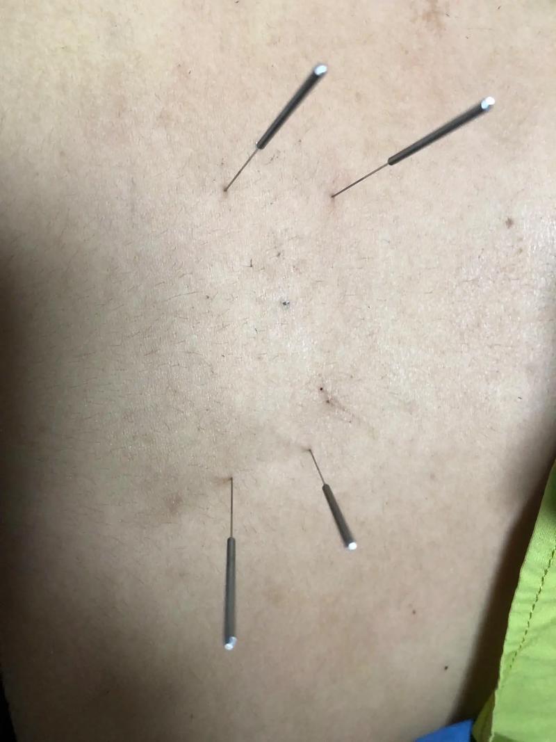 腰椎增生可以针灸吗