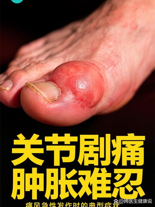 痛风吃秋水仙碱多久好