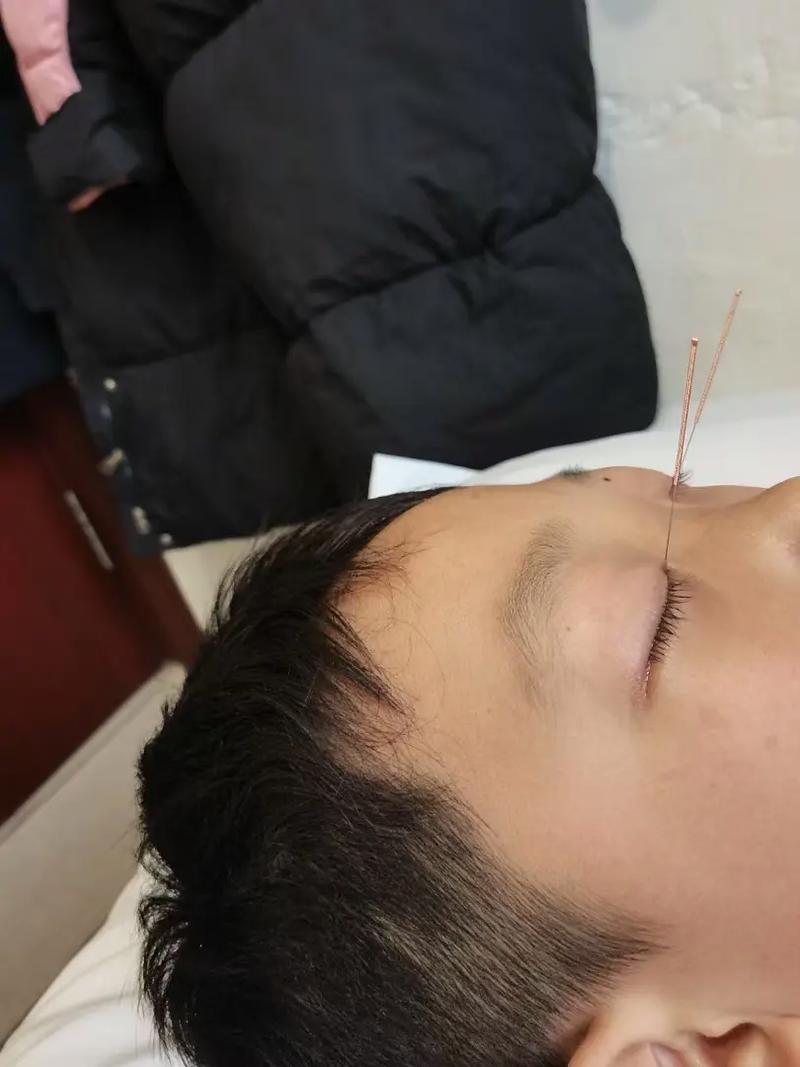 视网膜动脉阻塞针灸