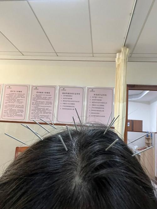 脂溢性脱发针灸治疗