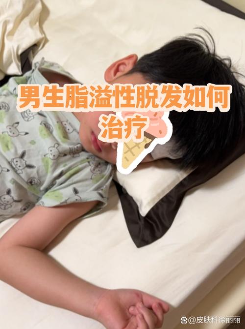 脂溢性脱发针灸治疗