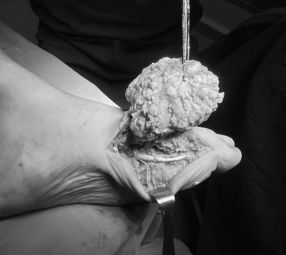 痛风结晶可以抽出来吗