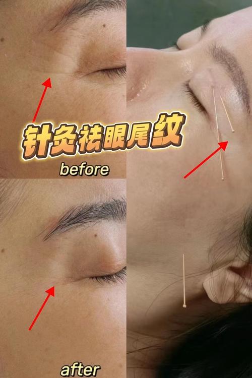 针灸去眼袋多久见效