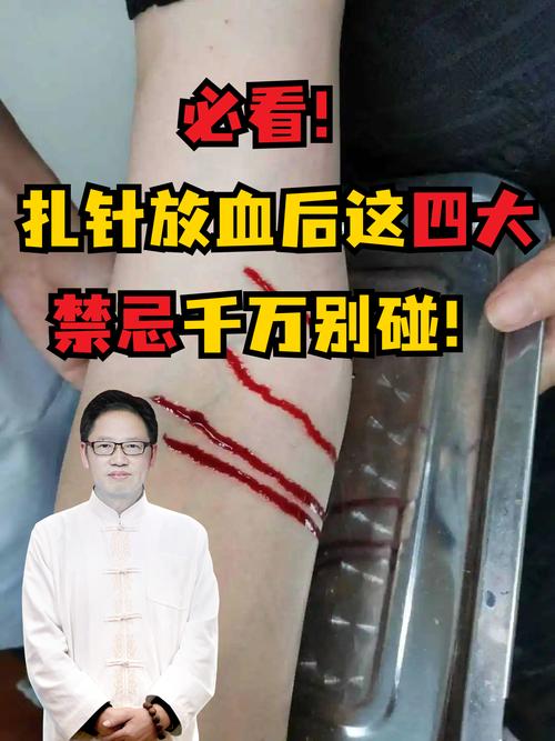 针灸为什么不会流血