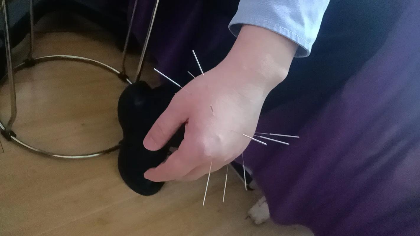 乳腺囊肿可以针灸吗