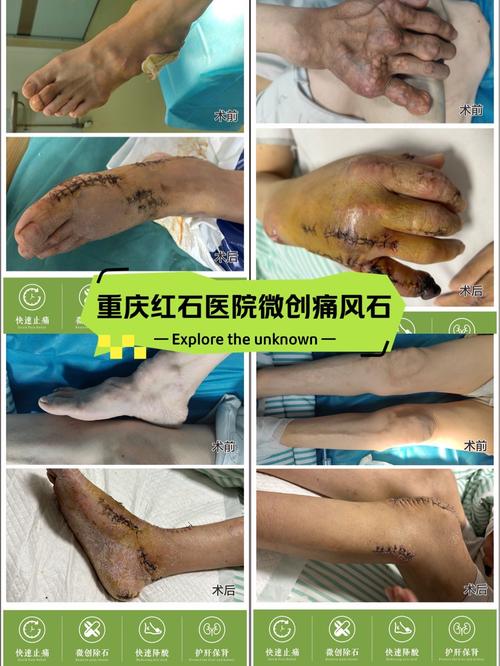 痛风结晶可以做手术吗