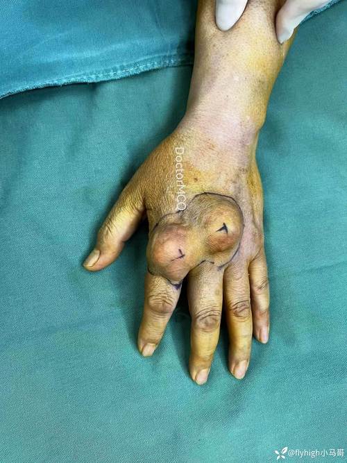 痛风结晶可以做手术吗