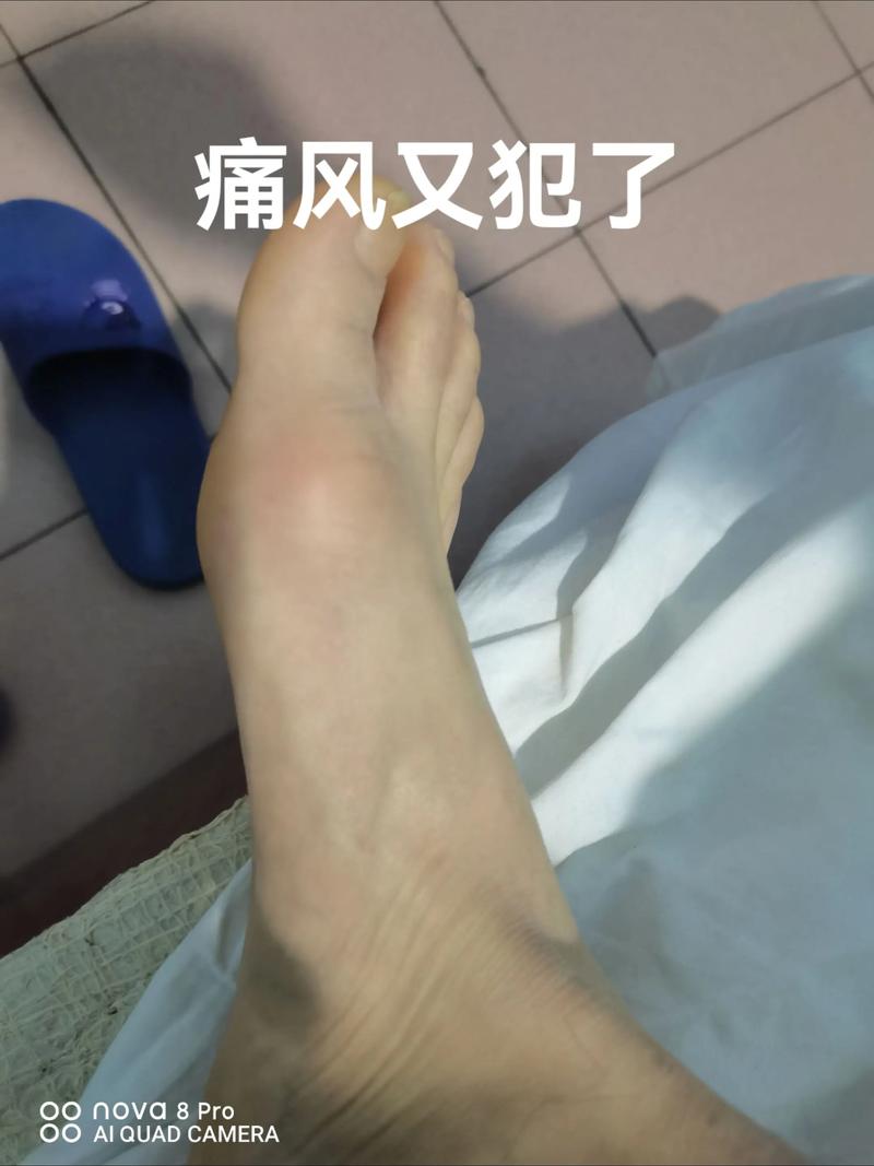 脚上有痛风结晶怎么办