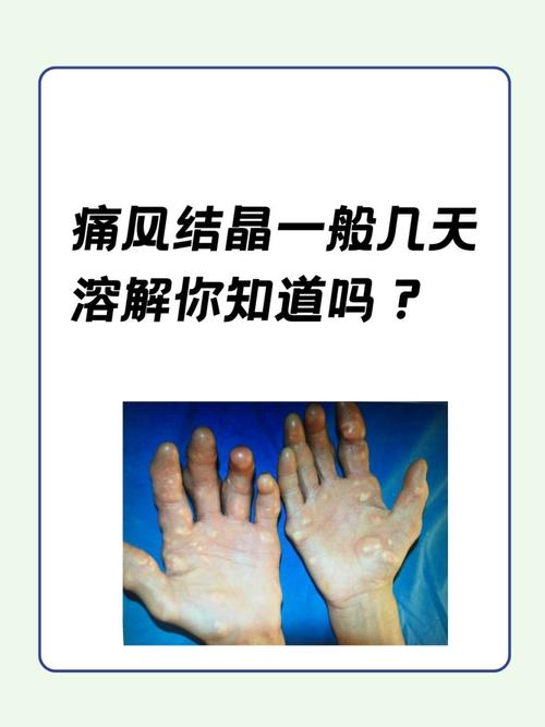 脚上有痛风结晶怎么办