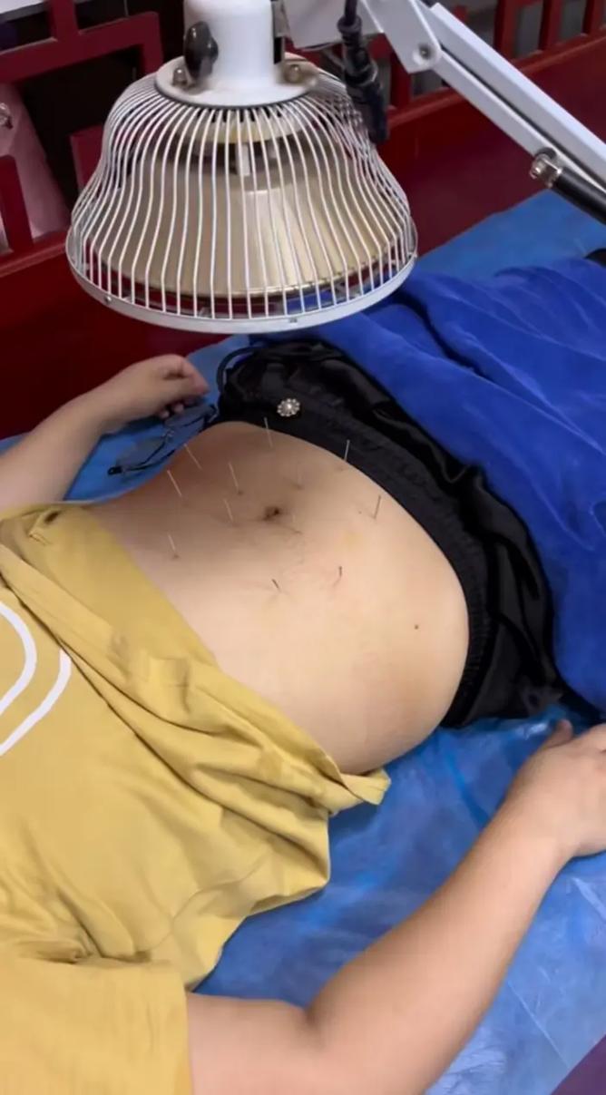 针灸完了后全身发热