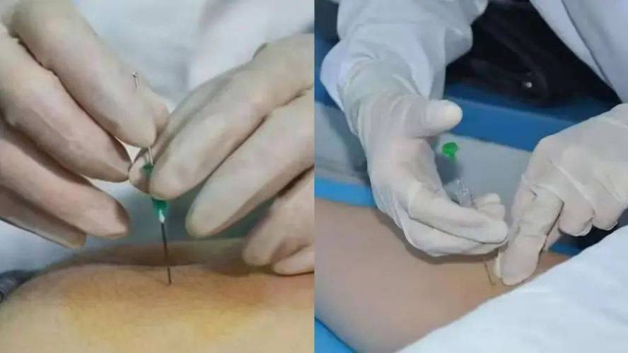 针灸埋线治疗肩周炎