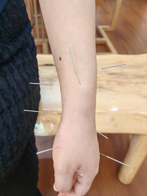 最快的针灸进针手法