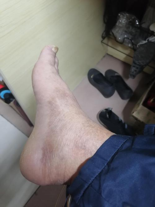 脚上痛风什么症状图片