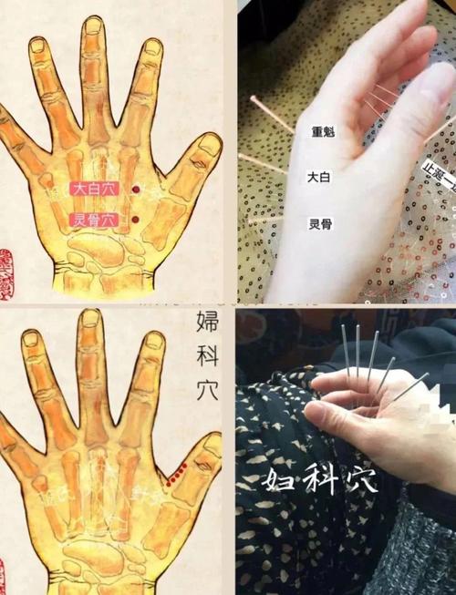 针灸可以治不孕不育