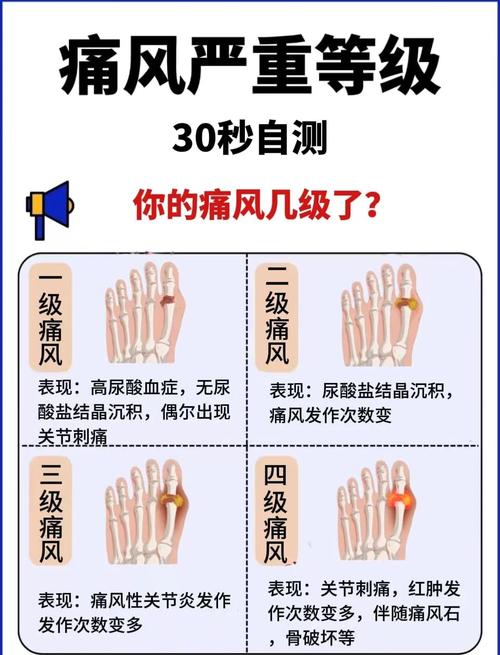 如何判断是否得了痛风