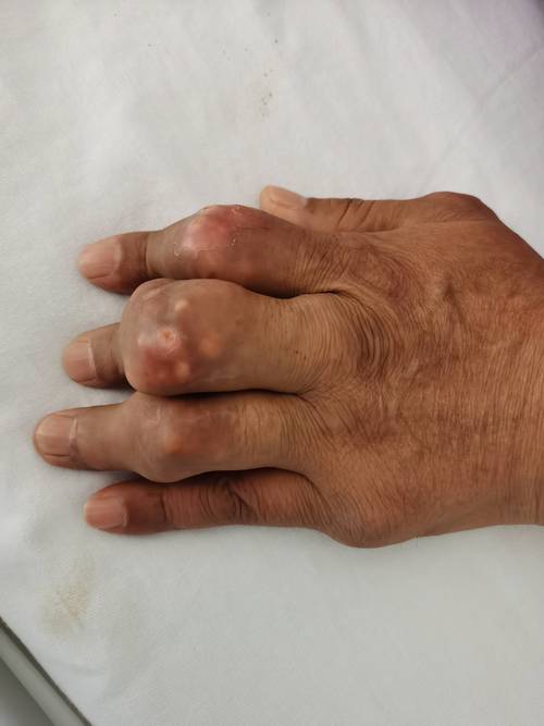 深圳痛风医院排名第一